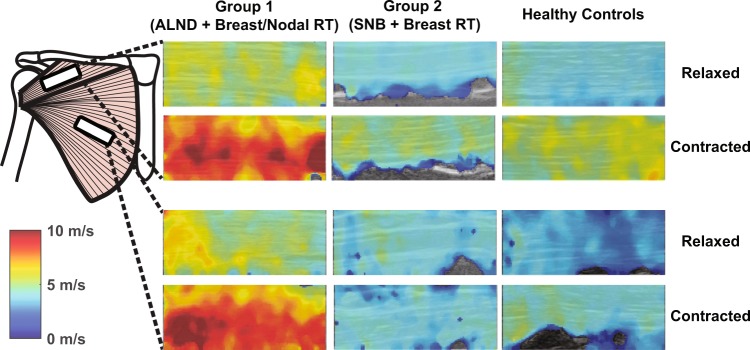 Shear-wave elastography stiffness maps of the pectoralis major across breast cancer treatment groups and healthy controls, relaxed and contracted.